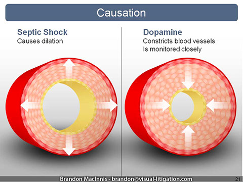 Medical Malpractice Trial Graphic - Septic shock causes dilation on blood vessel - Dopamine constricts blood vessels.