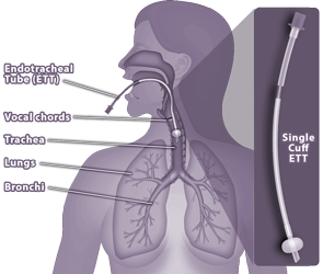 Medical Illustration showing endotracheal tube, lungs and respiratory system
